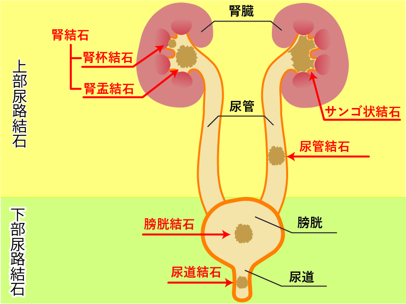 その他の腎臓結石の症状